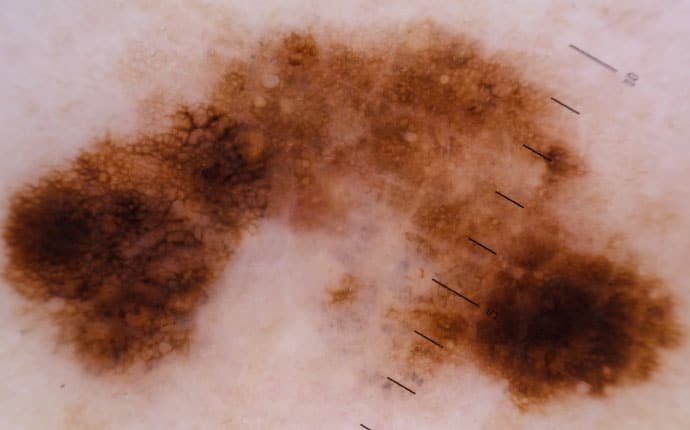 melanoma_dermatoscopia digital