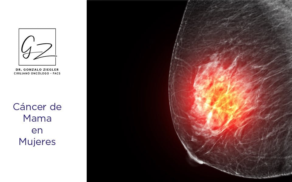 cancer de mama en mujeres