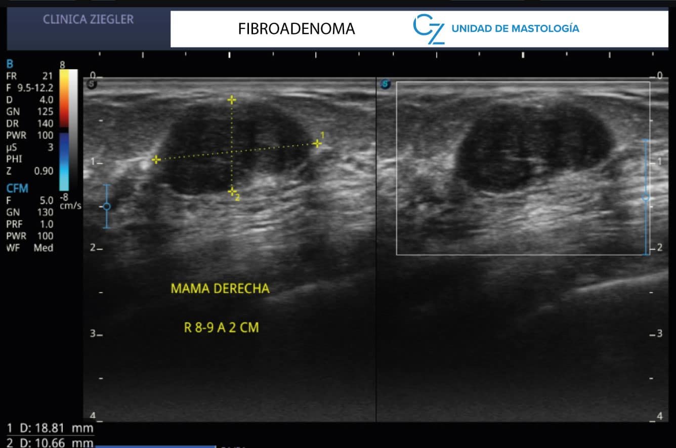 fibroadenoma ecografia