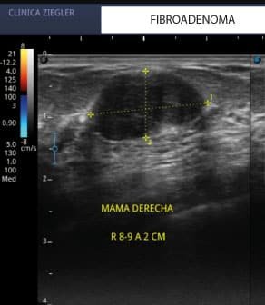 fibroadenoma ecografia
