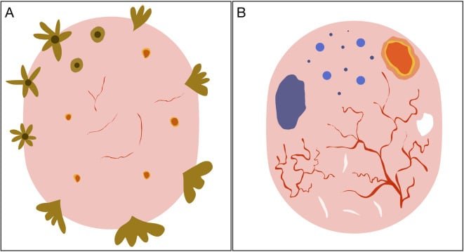 carcinoma basocelular dermatoscopia dibujo