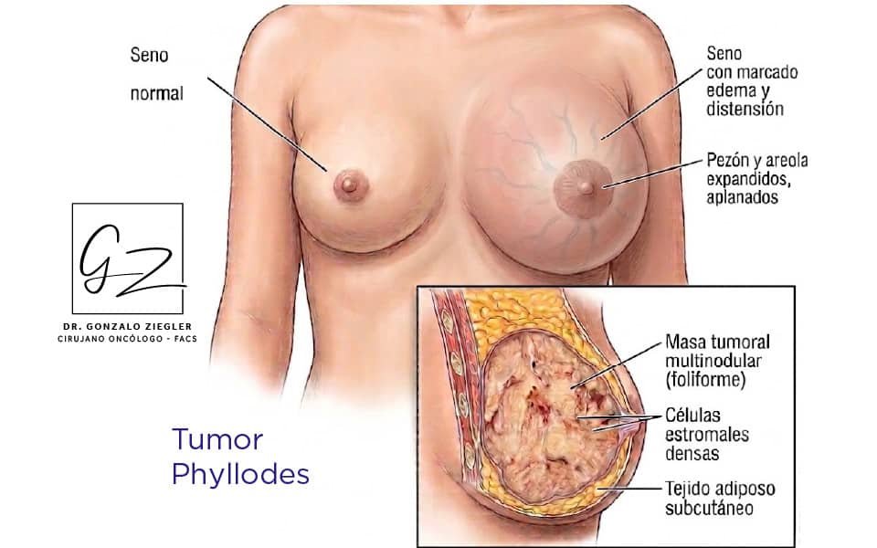Tumor Phyllodes Ilustracion